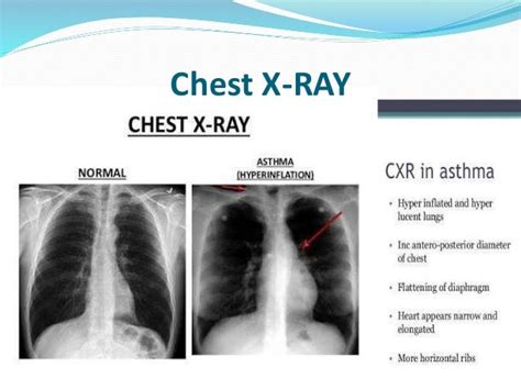 asthma x ray findings